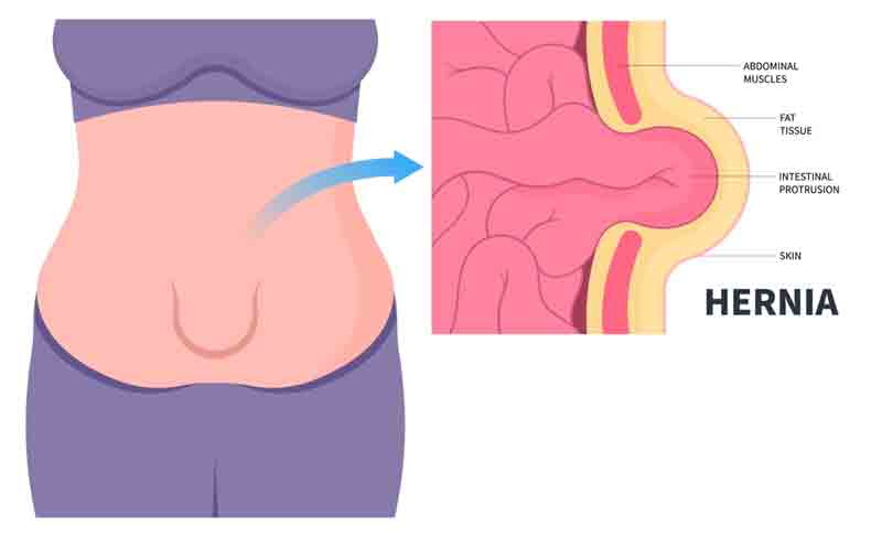 What’s The Link Between Hernias and Constipation